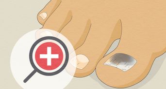 Treat Toe Nail Fungus