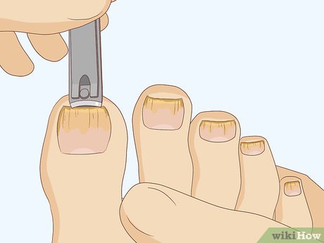 Image titled Cure Toenail Fungus with Vinegar Step 1