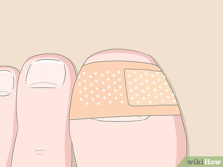 Image titled Relieve Ingrown Toe Nail Pain Step 11