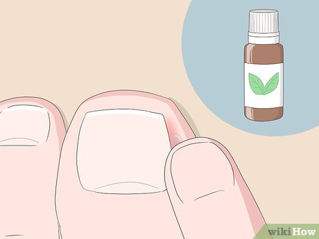 Image titled Relieve Ingrown Toe Nail Pain Step 13