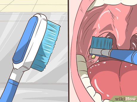 Image titled Remove Tonsil Stones (Tonsilloliths) Step 8