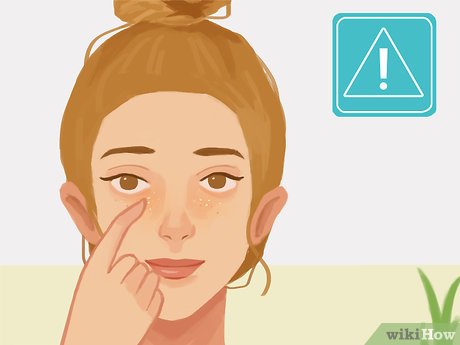 Image titled Remove Under Eye Milia Step 6