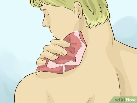 Image titled Remove a Hickey Step 2