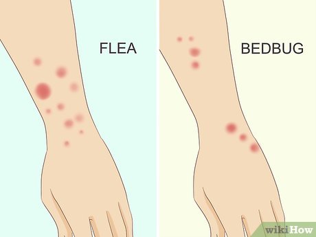 Image titled Treat Bed Bug Bites Step 1