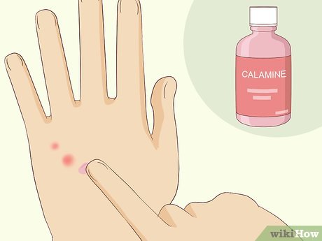 Image titled Treat Bed Bug Bites Step 9