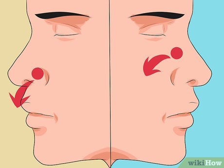 Step 1 Learn the types of nose bleeds.